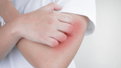 Got Keratosis Pilaris?  No Prescription Necessary